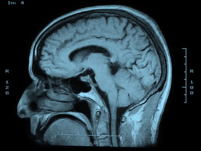 Fig. 1 (Click to enlarge). Magnetic resonance imagine (MRI) scans rely on stable and powerful magnetic fields that are achieved using superconductors. Known superconducting materials, however, require very low temperatures to exhibit the property of superconductivity.